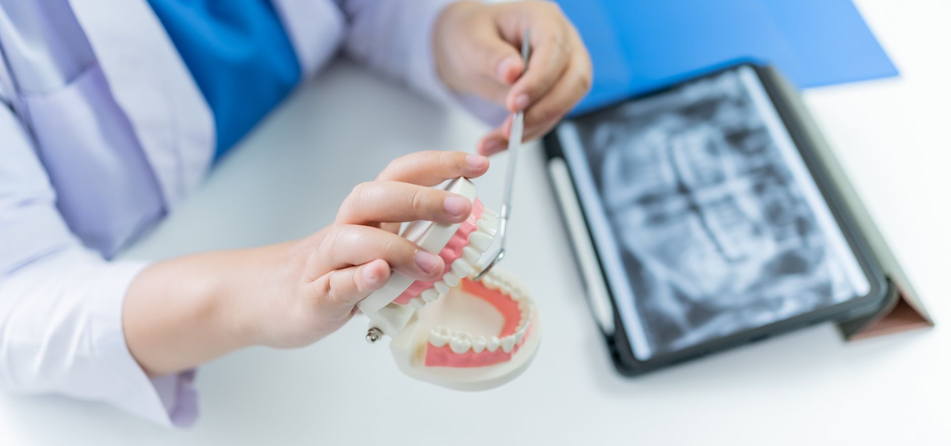 Implantes Dentales: Todo lo que Necesitas Saber Antes de Decidirte