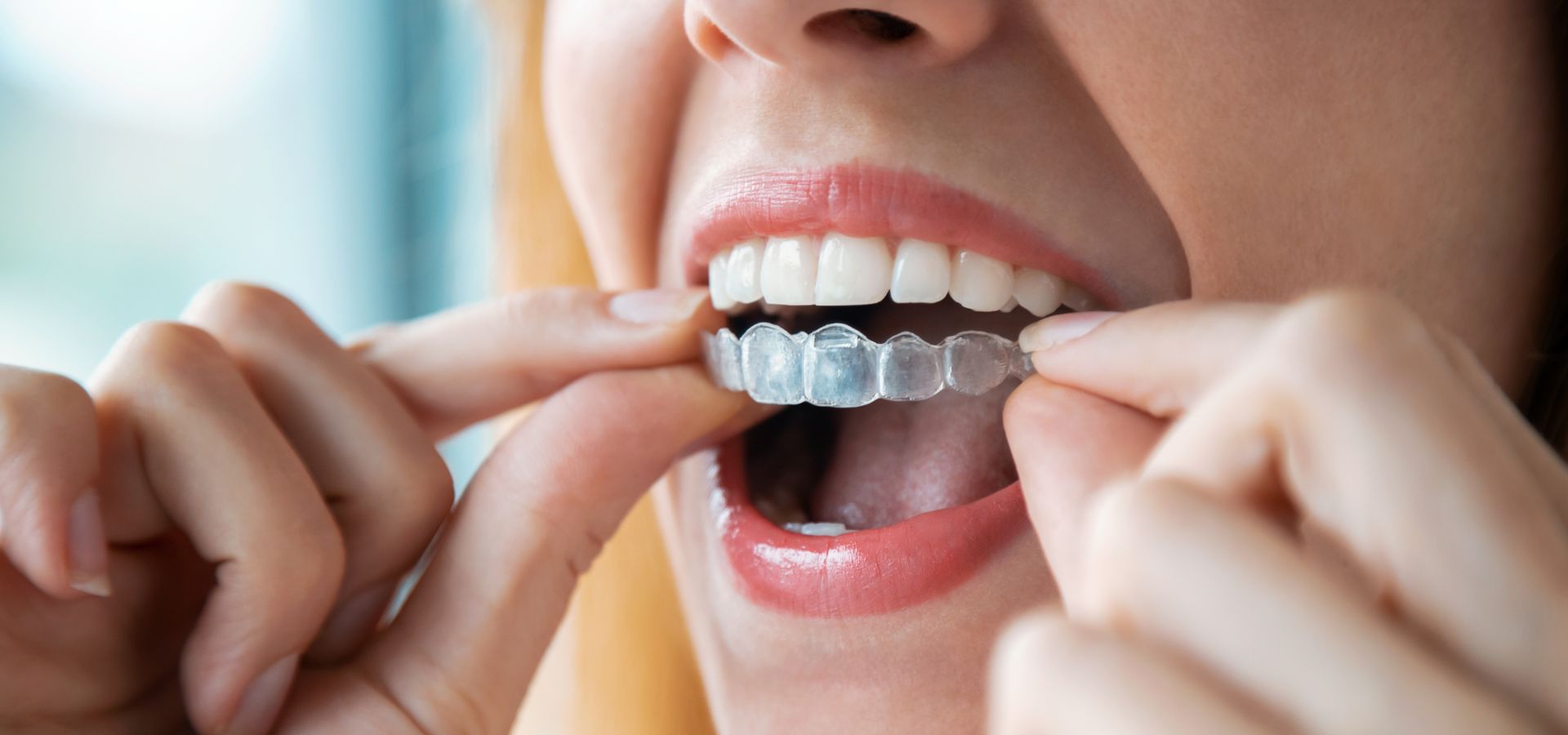 Cómo la ortodoncia mejora la mordida, la estética y la salud